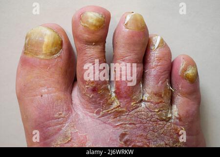 Pied de l'homme affecté par la maladie du pied de l'athlète (tinea pedis), France Banque D'Images