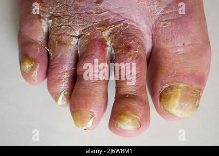 Pied de l'homme affecté par la maladie du pied de l'athlète (tinea pedis), France Banque D'Images