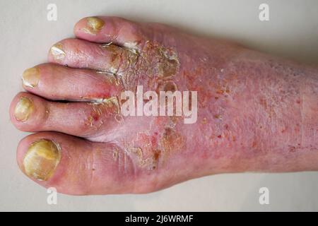 Pied de l'homme affecté par la maladie du pied de l'athlète (tinea pedis), France Banque D'Images