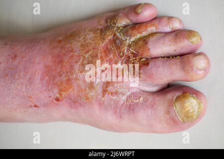 Pied de l'homme affecté par la maladie du pied de l'athlète (tinea pedis), France Banque D'Images