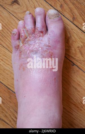 Pied de l'homme affecté par la maladie du pied de l'athlète (tinea pedis), France Banque D'Images