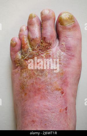 Pied de l'homme affecté par la maladie du pied de l'athlète (tinea pedis), France Banque D'Images