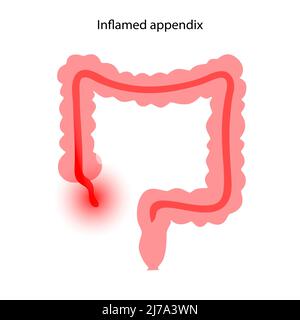 Annexe en forme d'inflammation, illustration conceptuelle Banque D'Images