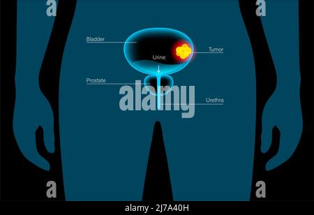 Stades du cancer de la vessie, illustration Banque D'Images