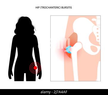 Bursite de la hanche, illustration conceptuelle Banque D'Images