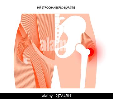 Bursite de la hanche, illustration conceptuelle Banque D'Images