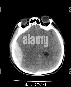 Lésions traumatiques cérébrales, scanner Banque D'Images