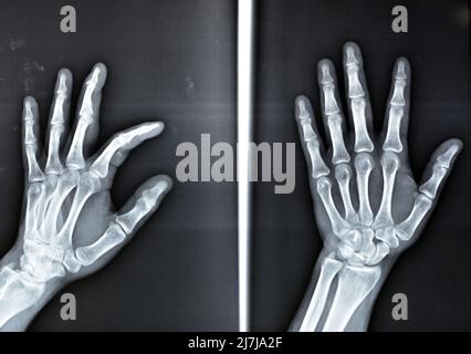 Une radiographie simple montre une base de fracture d'avulsion de la phalange distale du doigt central gauche, fracture d'un petit morceau d'os attaché à un tendon ou a Banque D'Images