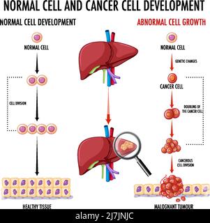 Schéma illustrant une cellule normale et une cellule cancéreuse Illustration de Vecteur