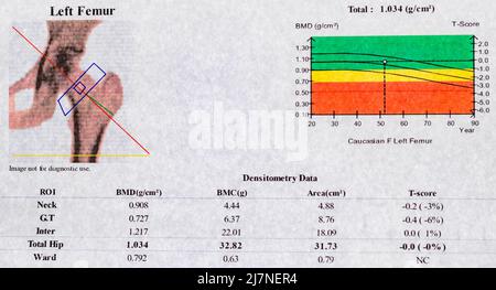 Photo en gros plan montrant un graphique, un diagramme et une courbe de la densité minérale osseuse (DMO), une méthode utilisée pour étudier l'ostéoporose chez les femmes de plus de 50 ans Banque D'Images