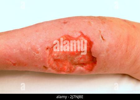 Grand ulcère trophique profond sur la jambe, défaut de la peau et des tissus mous. Complications des varices de la jambe inférieure, plaie trophique pleurant, eczéma, dermati Banque D'Images