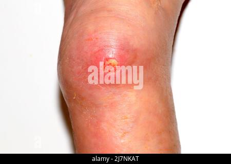 Grand ulcère trophique profond sur la jambe, défaut de la peau et des tissus mous. Complications des varices de la jambe inférieure, plaie trophique pleurant, eczéma, dermati Banque D'Images