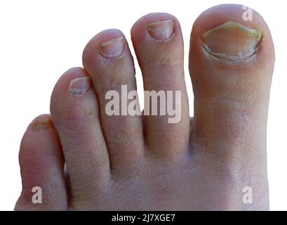 Gros plan d'un pied mâle avec un champignon jaune laid sur les ongles du pied isolé sur un fond blanc. Infection fongique des ongles. Stade avancé de la maladie. Haut vi Banque D'Images