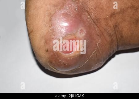 Diabète ulcère du pied dans le pied de patient asiatique. Vue en gros plan. Banque D'Images