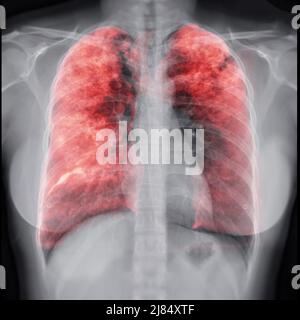 Radiographie thoracique avec Lung 3D image de rendu pour le diagnostic TB, tuberculose et covid-19 . Banque D'Images