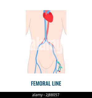 Cathéter veineux central fémoral, illustration Banque D'Images