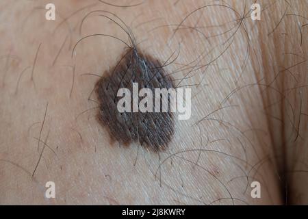 Une grosse mole de peau sur la jambe d'un jeune homme. Macro-image. Banque D'Images