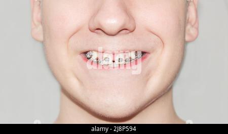 Jeune homme montrant des dents en croissance tortravers après avoir visité le dentiste et installé des bretelles. Photo de haute qualité Banque D'Images