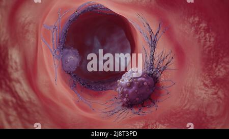 3D illustration d'une cellule cancéreuse.la propagation de la maladie dans le corps. Concept médical. Banque D'Images