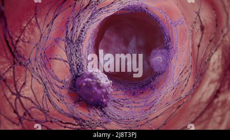 3D illustration d'une cellule cancéreuse.la propagation de la maladie dans le corps. Concept médical. Banque D'Images