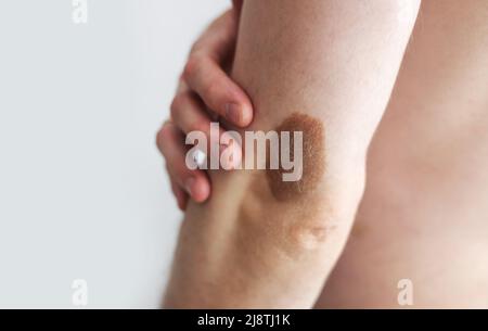 Grand nevus poilu sur le bras au sujet du coude de l'homme, espace pour le texte. Banque D'Images
