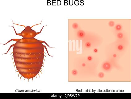 Punaise de lit. Adulte femelle de Cimex lectularius. Gros plan de la peau avec des piqûres de rouge et de démangeaison souvent en ligne. Grossissement d'un insecte. Vue de dessus Illustration de Vecteur