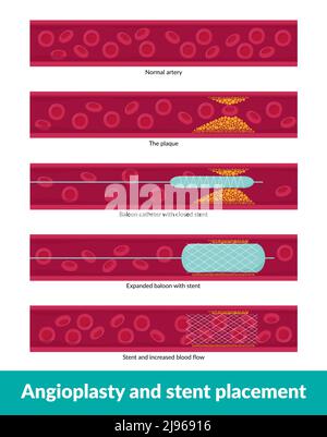 Angioplastie avec placement du stent. Un petit cathéter à ballonnet est inséré dans un vaisseau sanguin obstrué pour l'élargir et améliorer le flux sanguin Illustration de Vecteur