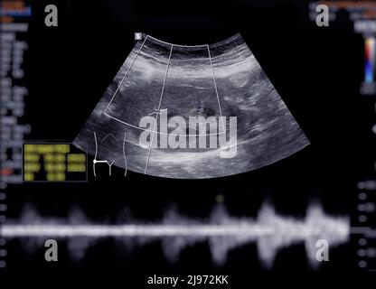 Échographie du haut de l'abdomen montrant les reins. Banque D'Images