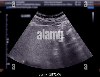 Échographie du haut de l'abdomen montrant le foie. Banque D'Images