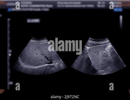 Échographie du haut de l'abdomen montrant le foie. Banque D'Images