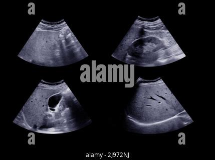 Échographie de l'abdomen supérieur montrant le foie, la vésicule biliaire et les reins. Banque D'Images