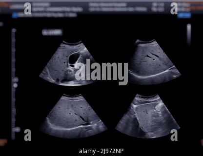 Échographie du haut de l'abdomen montrant la vésicule biliaire pour le diagnostic de la calculs de vésicule biliaire. Banque D'Images