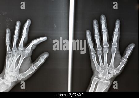 Une radiographie simple montre une base de fracture d'avulsion de la phalange distale du doigt central gauche, fracture d'un petit morceau d'os attaché à un tendon ou a Banque D'Images