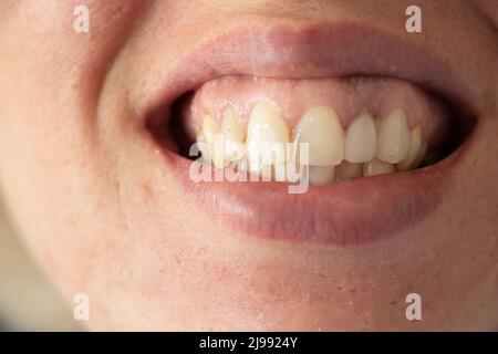 dents jaunes torolées d'une jeune fille en gros plan, croissance ouverte avec de mauvaises dents par exemple, dents et bouche, caries Banque D'Images