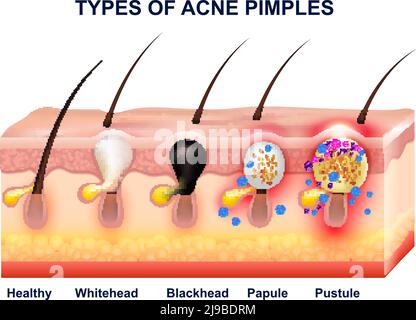 Composition de l'anatomie d'acné de peau colorée avec types de boutons d'acné illustration vectorielle avant et après Illustration de Vecteur