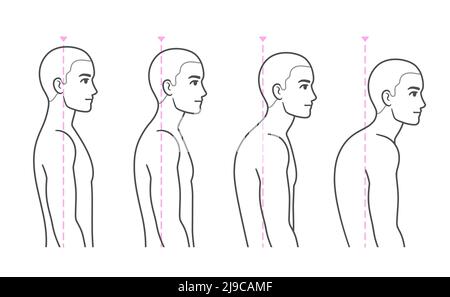 Stades de progression de la cyphose de la colonne vertébrale. Jeune homme avec dos et épaules arrondis, syndrome de la tête avant. Problèmes de posture du dos diagramme médical, vecteur malade Illustration de Vecteur