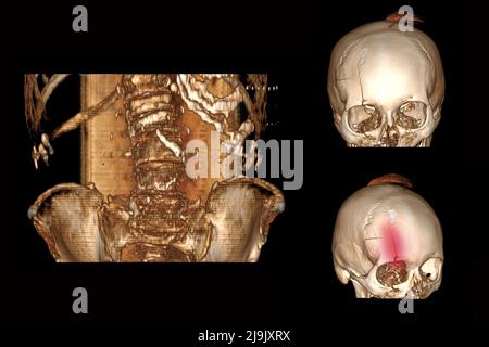 tomodensitométrie de la colonne vertébrale avec une fracture des vertèbres et leur déplacement par rapport à cette personne et un crâne avec une fracture sur le front, Banque D'Images