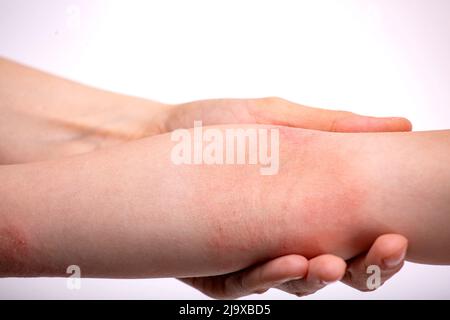 La main d'un enfant avec une dermatite atopique Banque D'Images