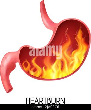 Estomac d'organe interne humain réaliste avec brûlures d'estomac sur fond blanc illustration vectorielle Illustration de Vecteur