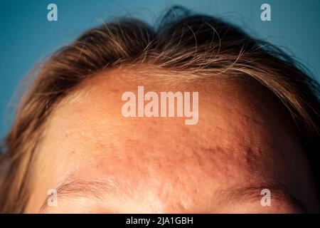 post-acné, cicatrices et boutons de festing rouges sur le visage d'une jeune femme. Banque D'Images