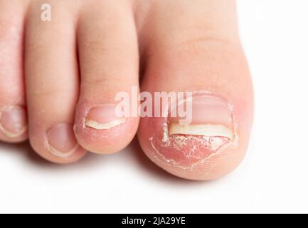 Prise de vue d'un doigt d'un enfant présentant une infection fongique des ongles sur fond blanc. Banque D'Images