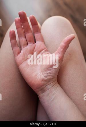 Main de la jeune femme avec le syndrome d'Ehlers-Danlos sur ses genoux, avec une peau très sèche et serrée, EDS peau froissée sans être dans l'eau Banque D'Images