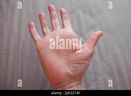 Main de la personne atteinte du syndrome d'Ehlers-Danlos, avec une peau sèche et extensible à l'ancienne, peau froissée EDS Banque D'Images