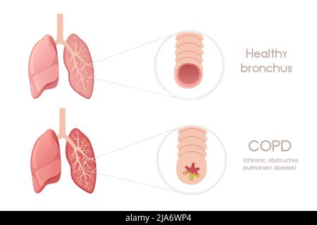 Poumons humains bronchi avec bronchite dessin animé anatomie humaine illustration vectorielle d'organe sur fond blanc Illustration de Vecteur