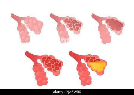 Ensemble de dessin animé Alveoli humain dessin d'anatomie humaine illustration de vecteur d'organe sur fond blanc Illustration de Vecteur