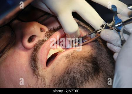 Un homme avec une barbe légère subissant une procédure dentaire Banque D'Images