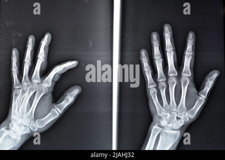 Une radiographie simple montre une base de fracture d'avulsion de la phalange distale du doigt central gauche, fracture d'un petit morceau d'os attaché à un tendon ou a Banque D'Images