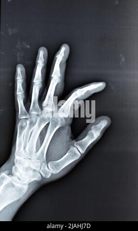 Une radiographie simple montre une base de fracture d'avulsion de la phalange distale du doigt central gauche, fracture d'un petit morceau d'os attaché à un tendon ou a Banque D'Images