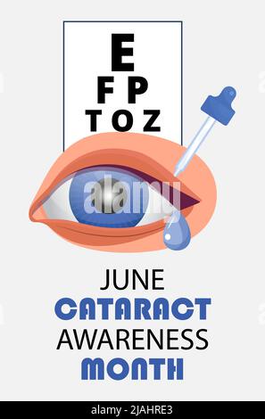 Le mois de la sensibilisation à la cataracte est célébré en juin. Maladie de glaucome et problèmes de néphropathie. Ophtalmologiste, illustration du concept d'oculiste. Vue che Illustration de Vecteur