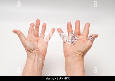 Main droite post-op gonflée de la contracture de Dupuytren avec la main gauche post-op guérie, paumes vers le haut. La main droite a des bandes de steri. Banque D'Images